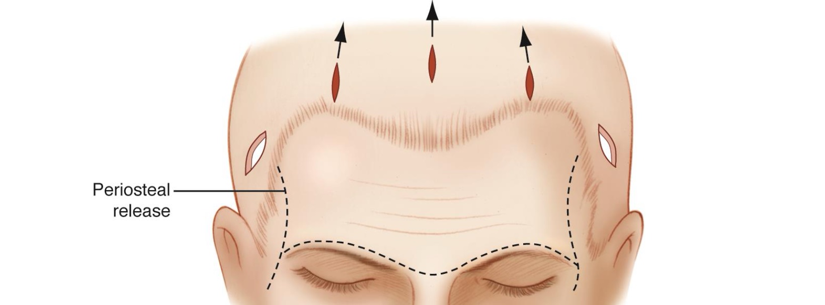 Illustration showing the small scalp incision locations used for an endoscopic brow lift