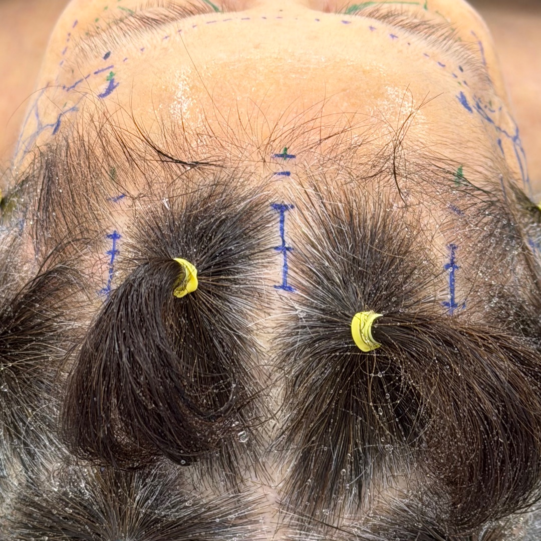 Preparation and incision sites for endoscopic brow lift