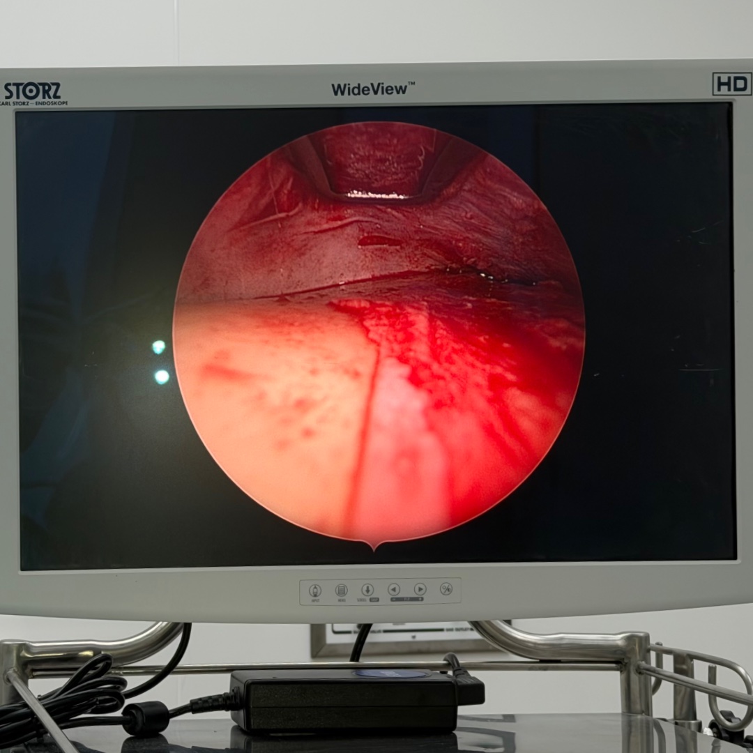 Endoscopic visualization during brow lift surgery