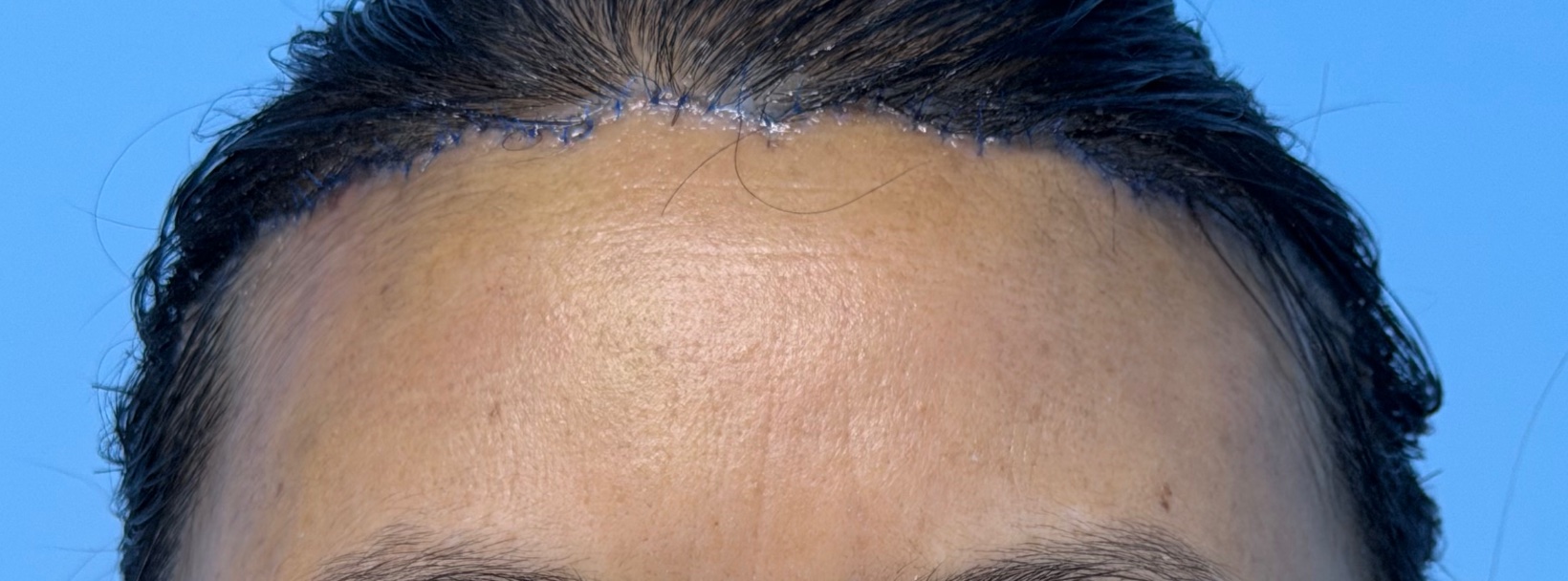 Clinical photograph showing the frontal hairline incision area used for a hairline forehead lift