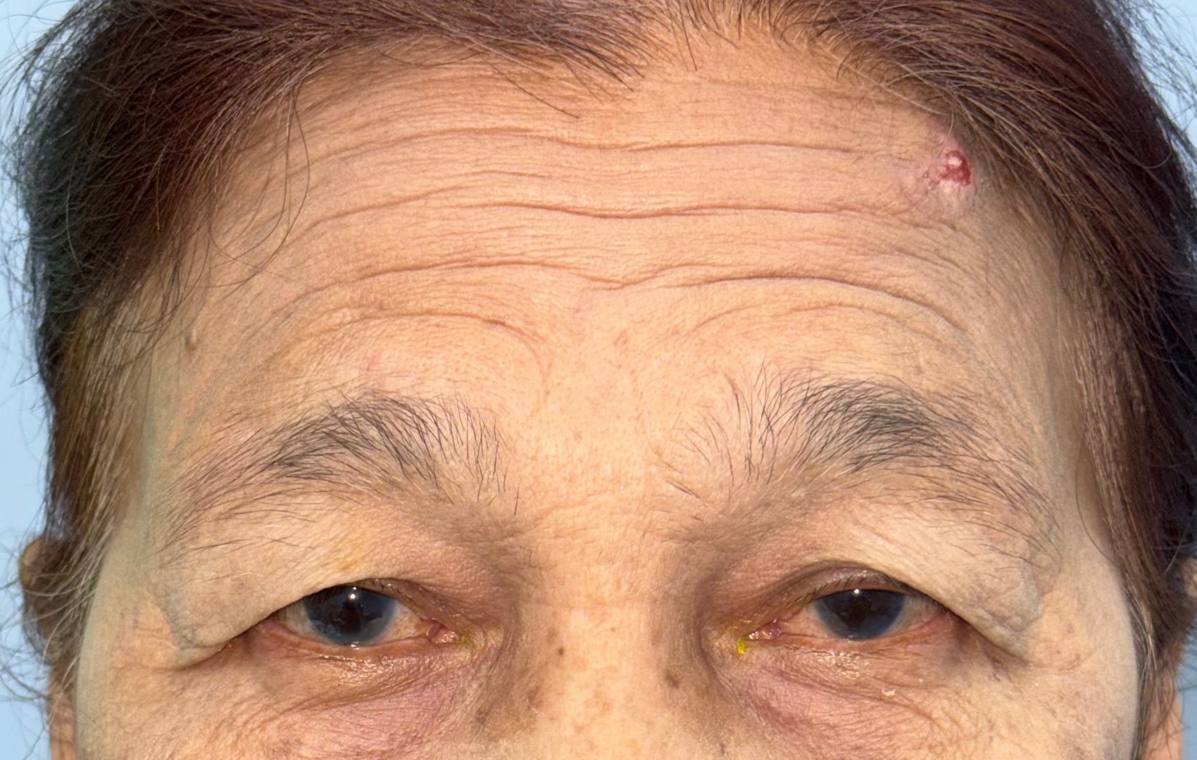 Clinical assessment for hairline forehead lift
