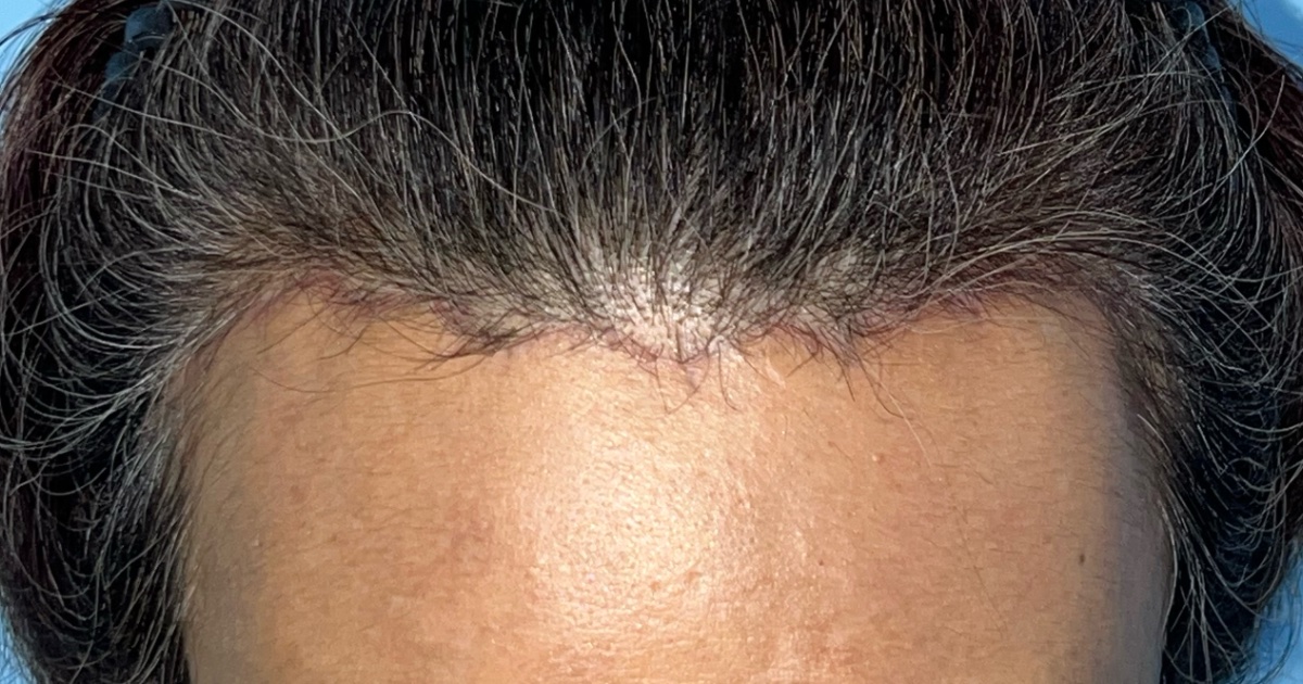 Hairline forehead lift recovery at 6 weeks