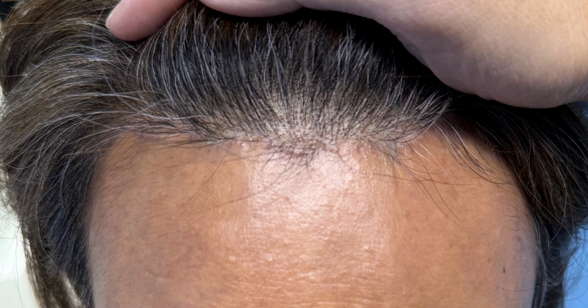 Hairline forehead lift recovery at 4 months