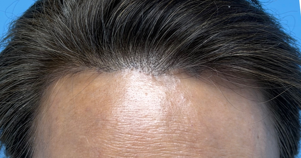 Hairline forehead lift recovery at 10 months
