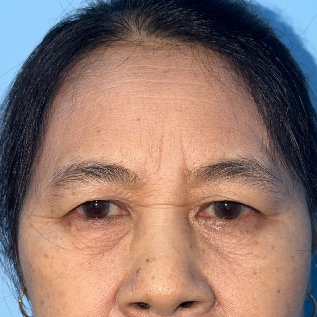 Preoperative view before hairline forehead lift
