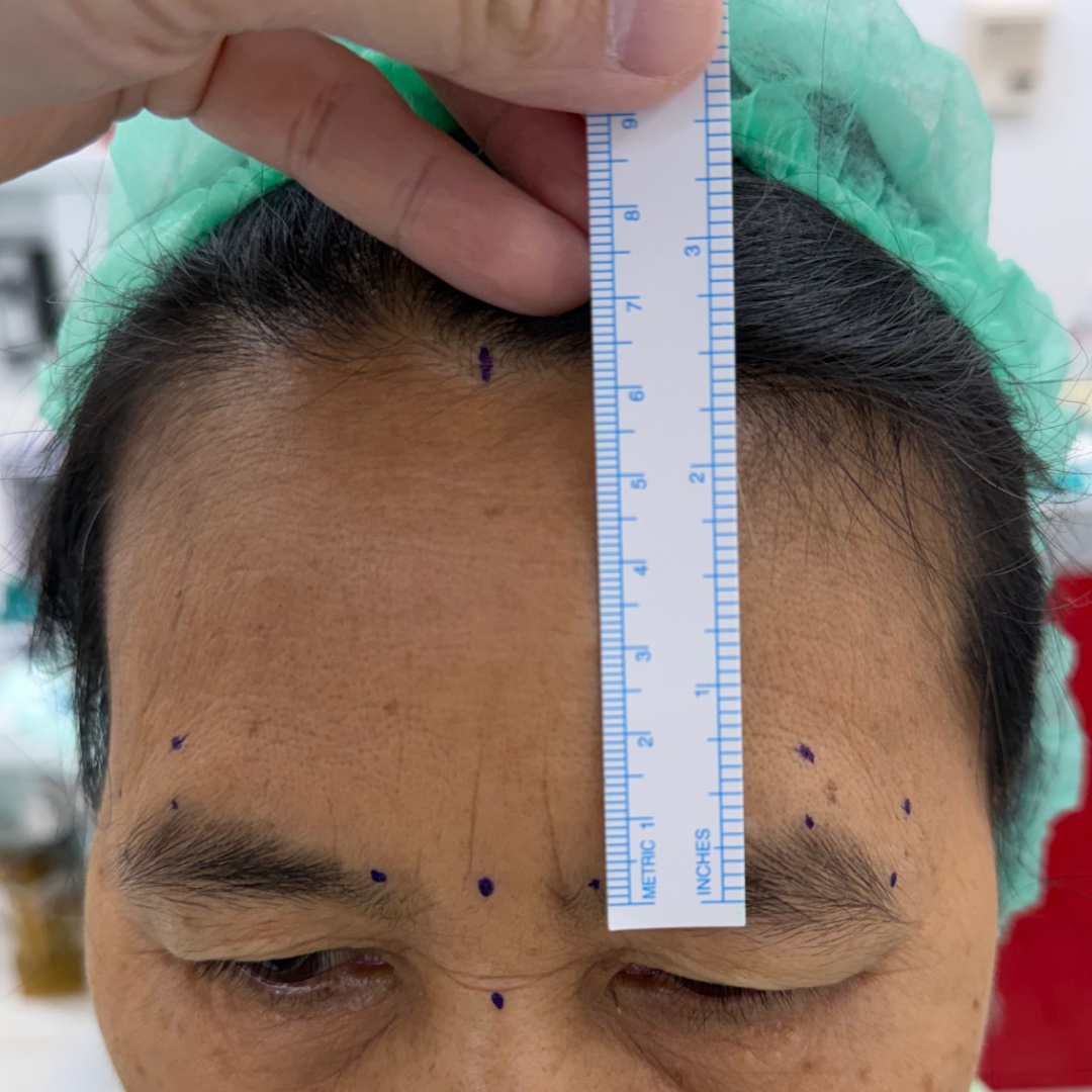 Forehead assessment before hairline forehead lift