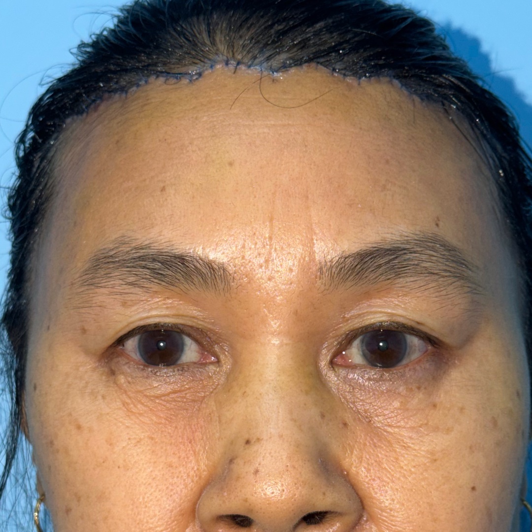 Immediate postoperative view after hairline forehead lift