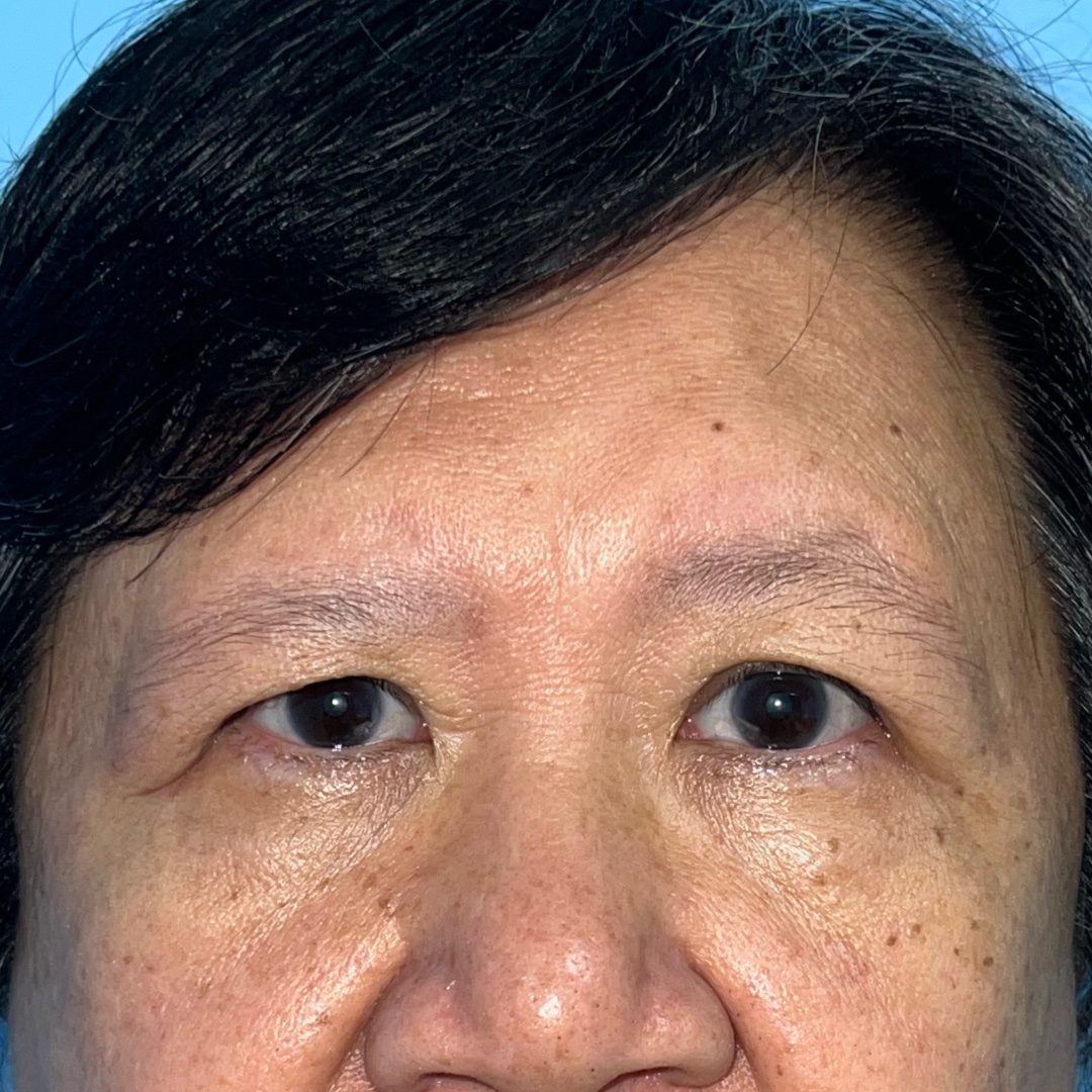 Before endoscopic brow lift