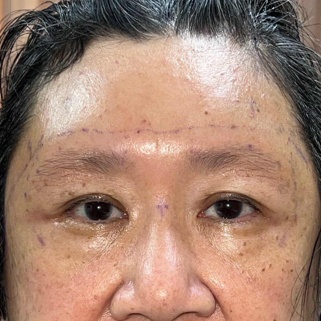 Endoscopic brow lift recovery at day 1
