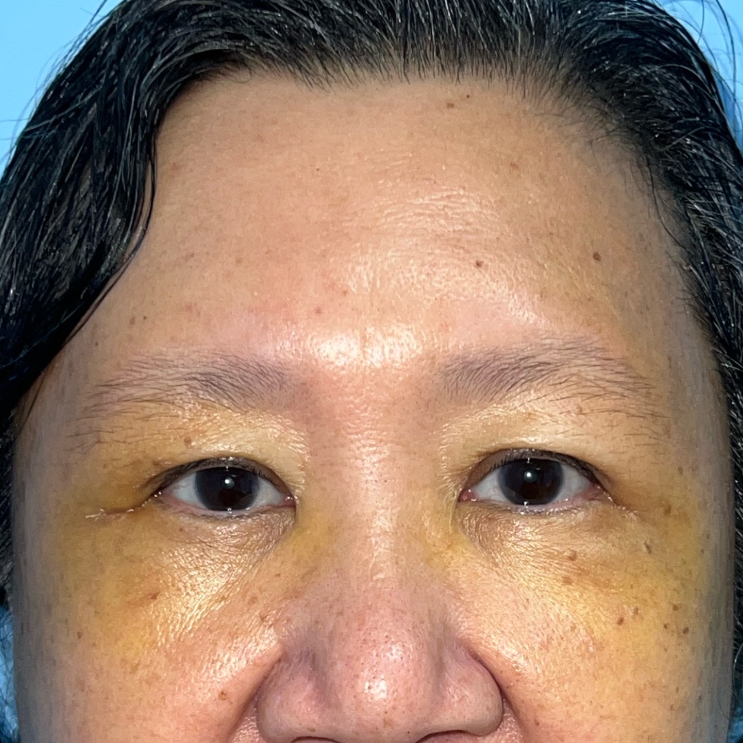Endoscopic brow lift recovery at day 6