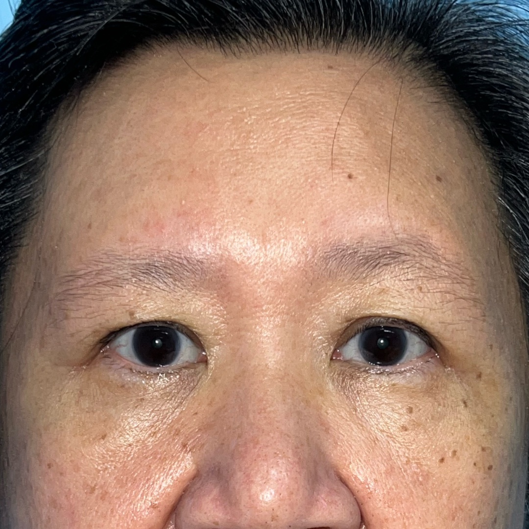 Endoscopic brow lift recovery at day 20