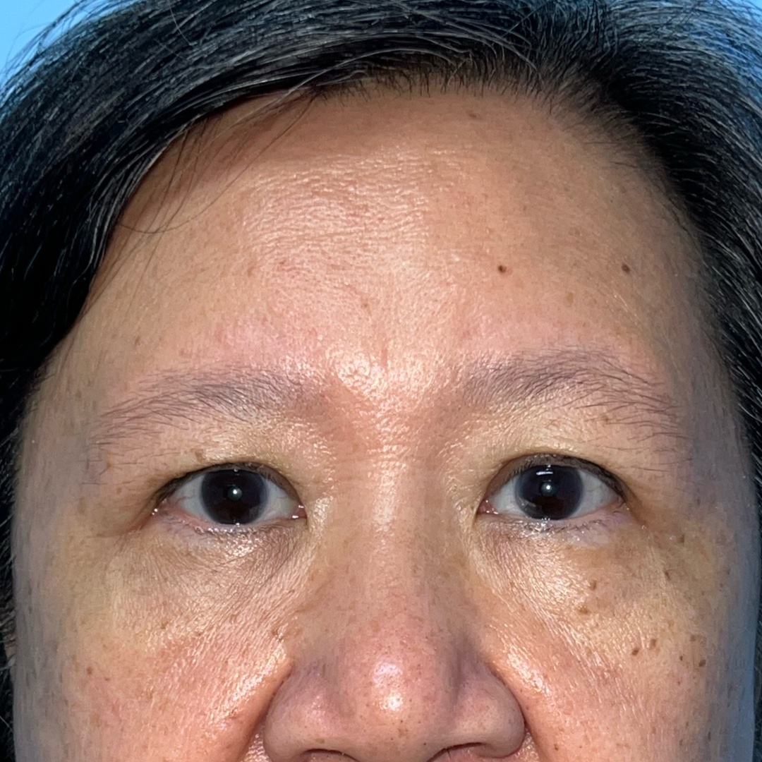 Endoscopic brow lift recovery at 2 months