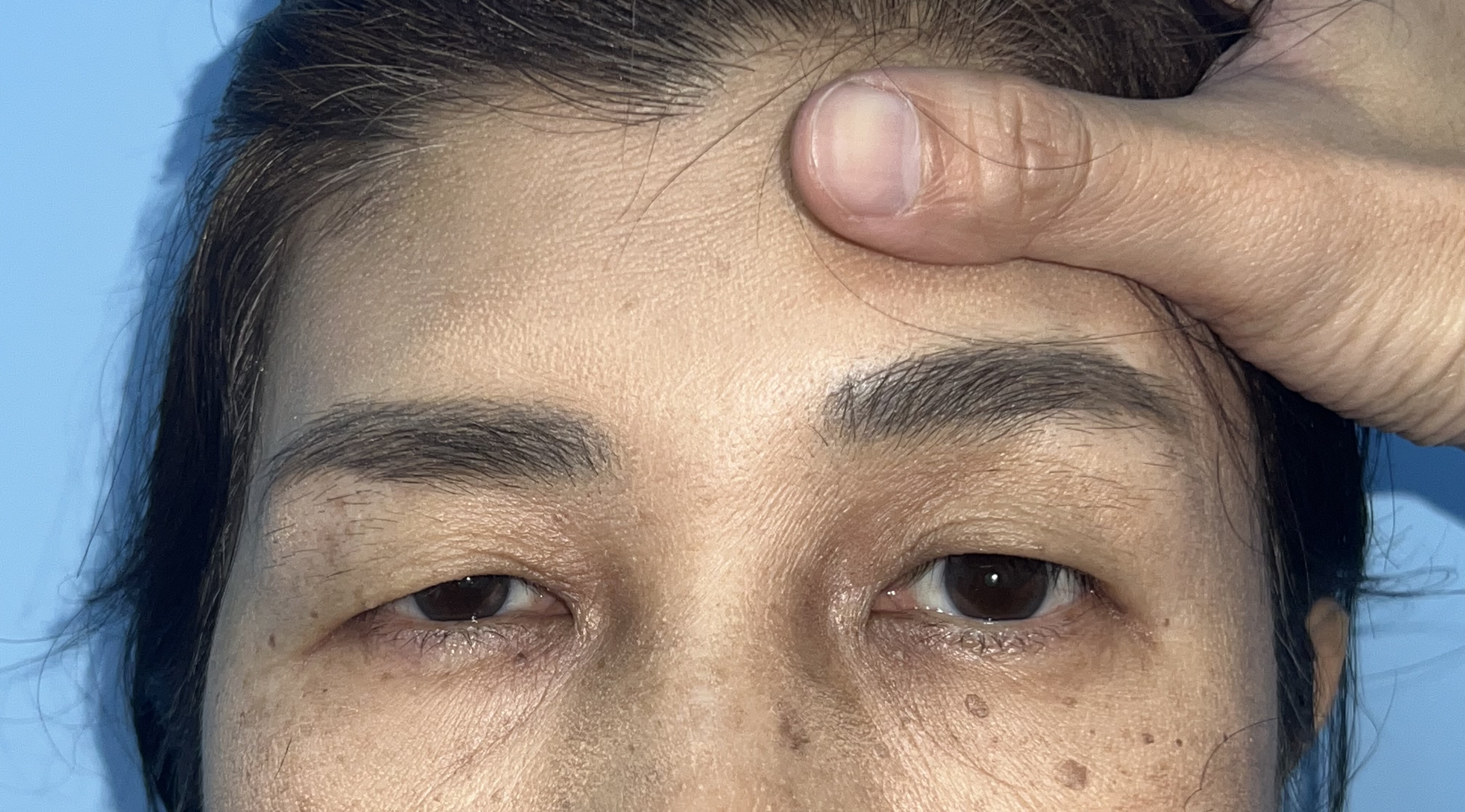 Clinical assessment of the eyelids and brow