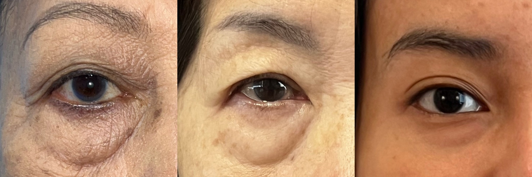 Clinical example of lower eyelid bags and under-eye contour