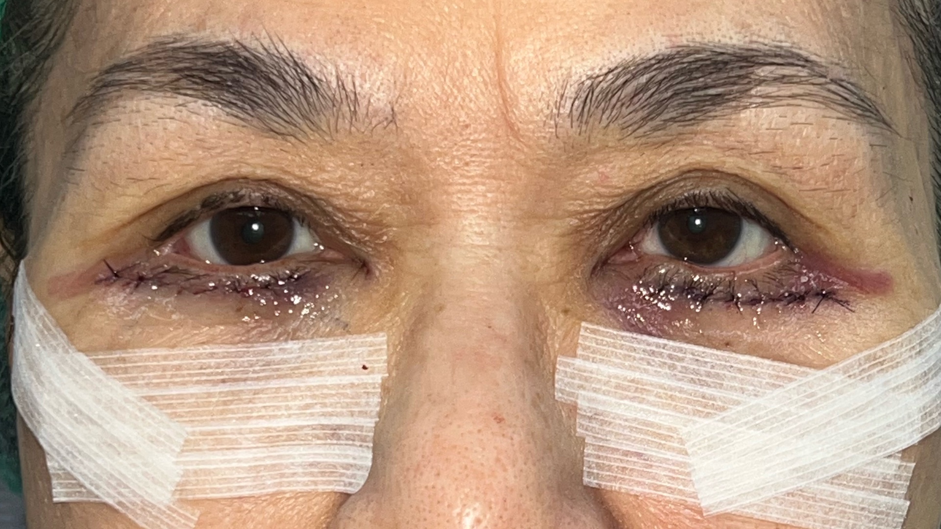 Lower blepharoplasty recovery on the day of surgery