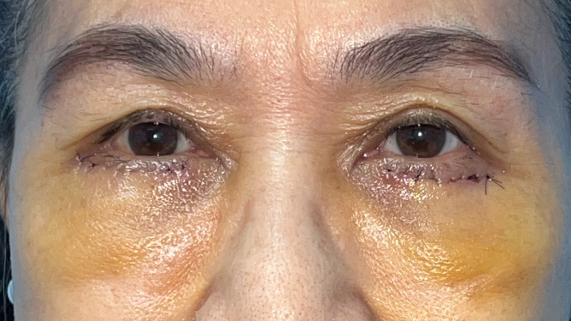 Lower blepharoplasty recovery at day 5
