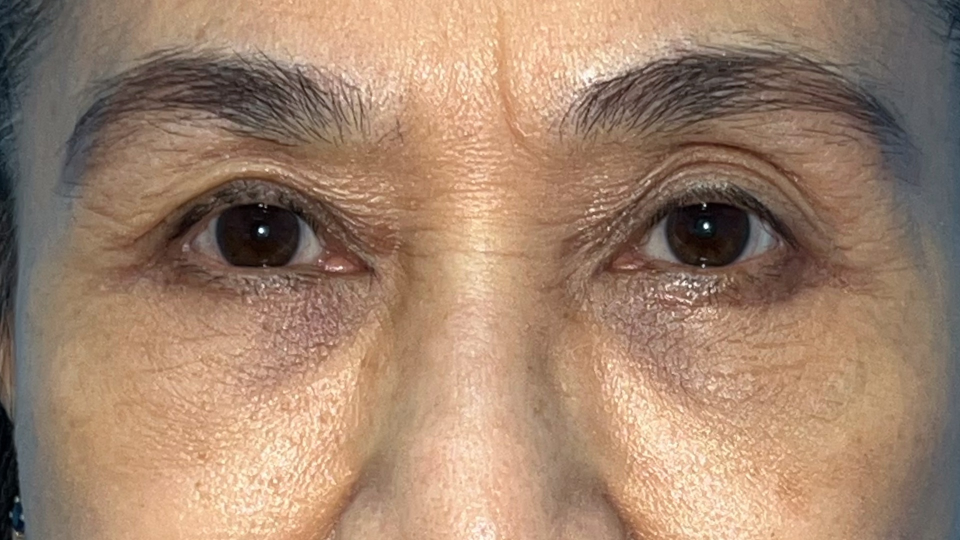 Lower blepharoplasty recovery at 1 month