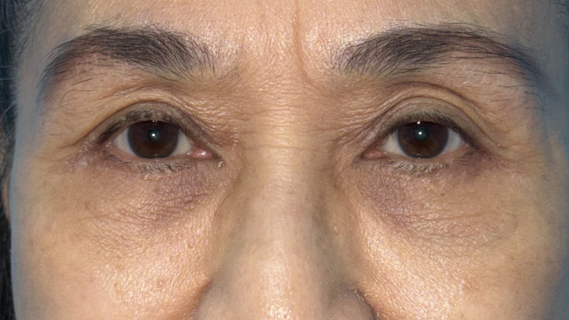 Lower blepharoplasty recovery at 4 months