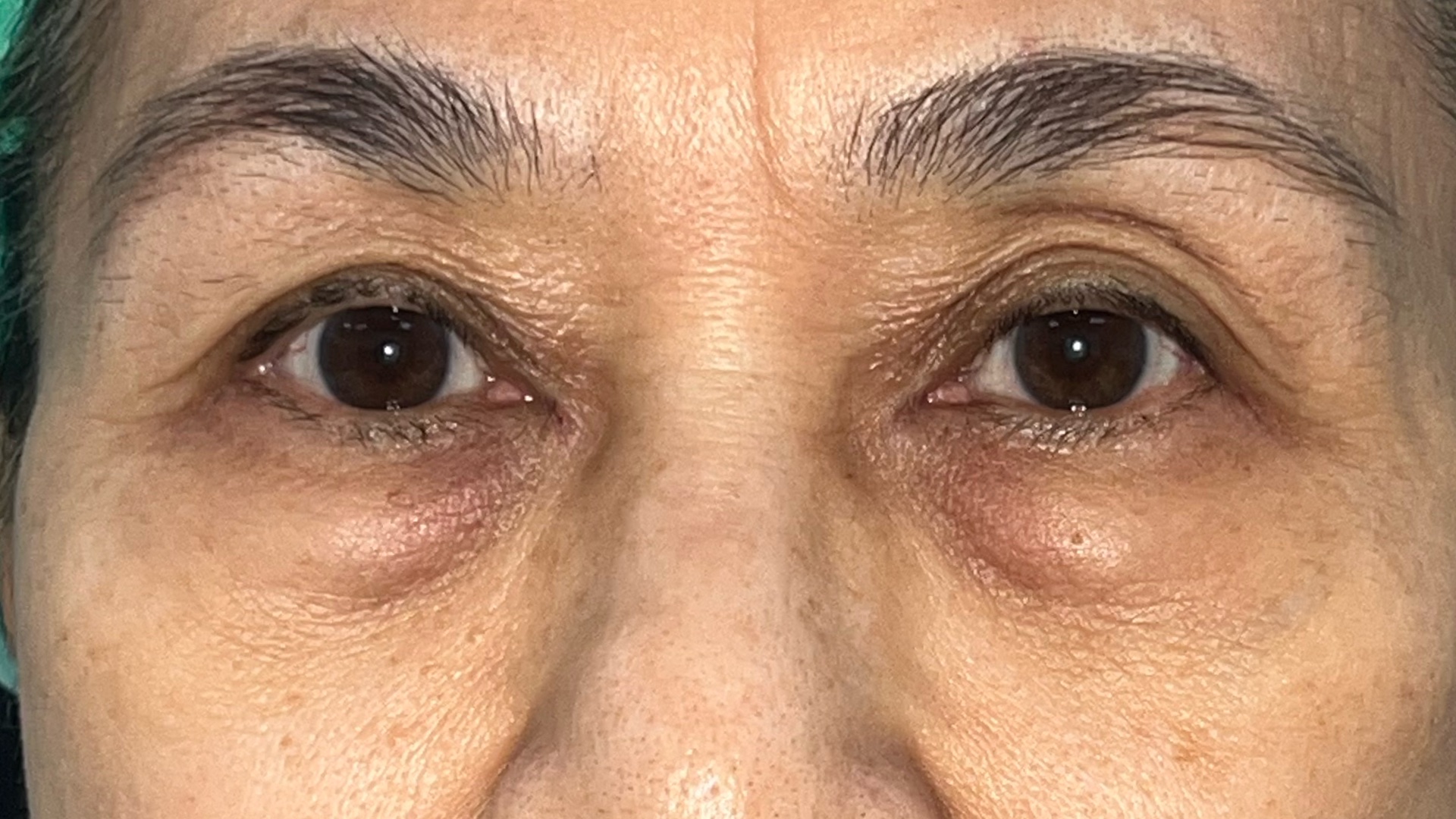 Lower blepharoplasty before surgery