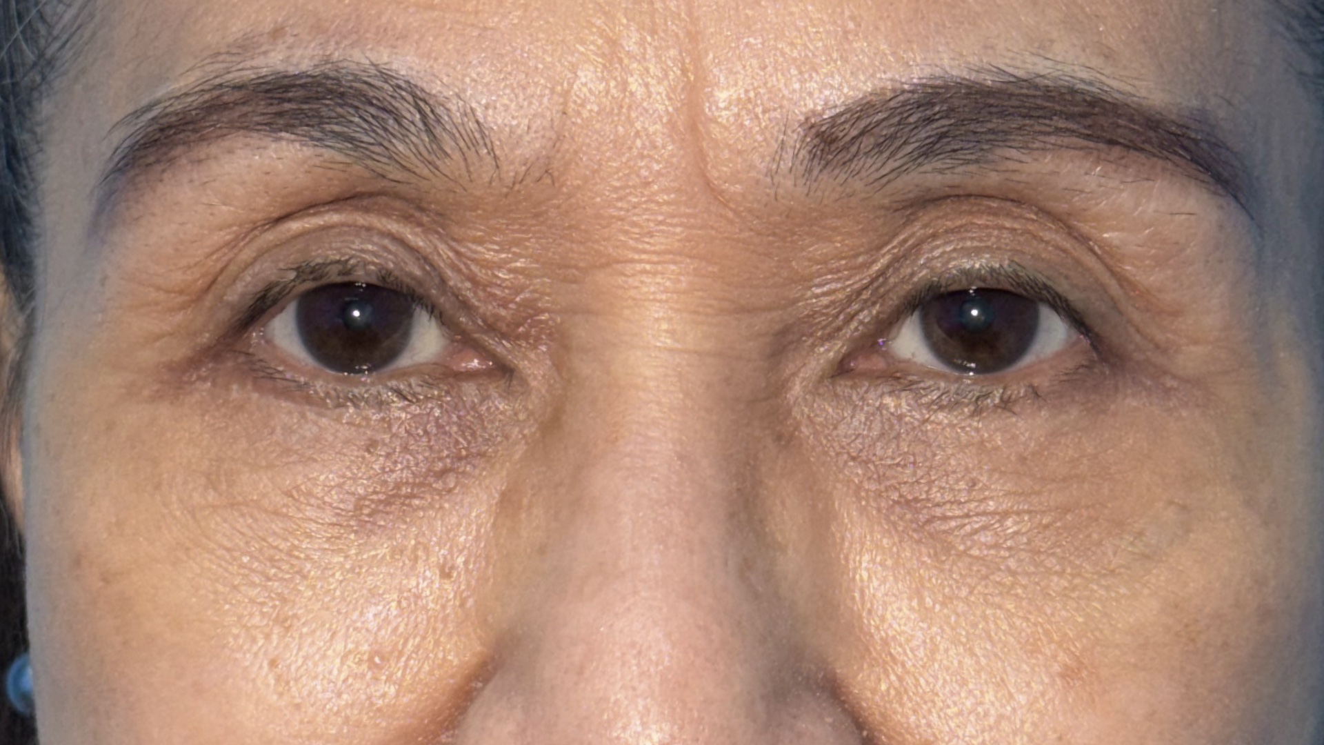 Lower blepharoplasty recovery at 1 year