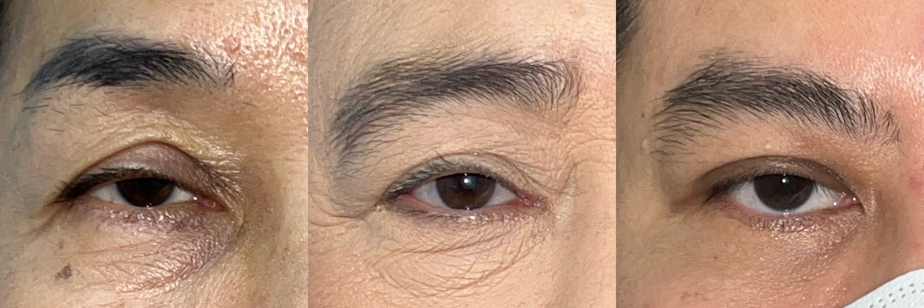 Clinical example of upper eyelid ptosis