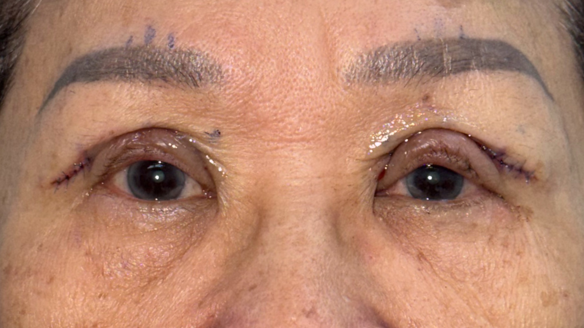 Immediately after ptosis surgery, day 0
