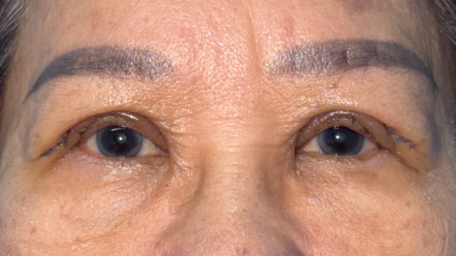 Ptosis surgery recovery at day 11