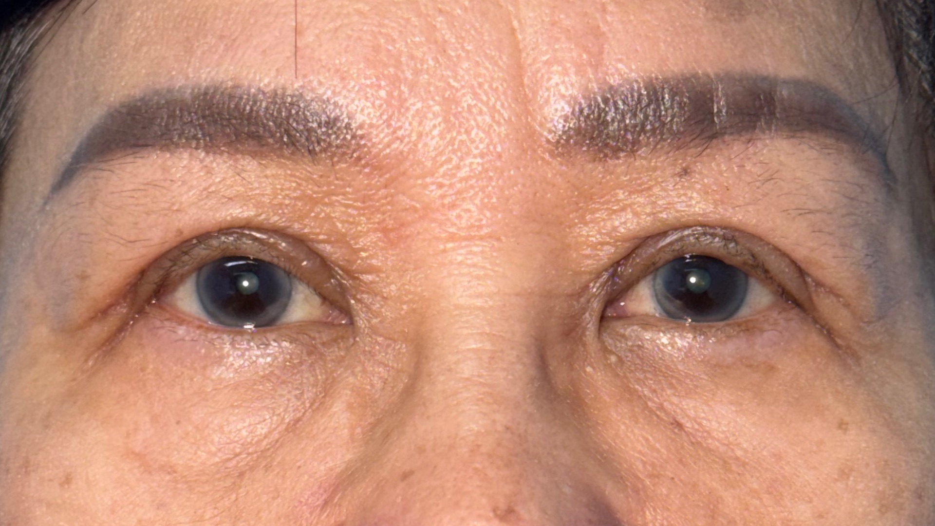 Ptosis surgery recovery at 6 weeks