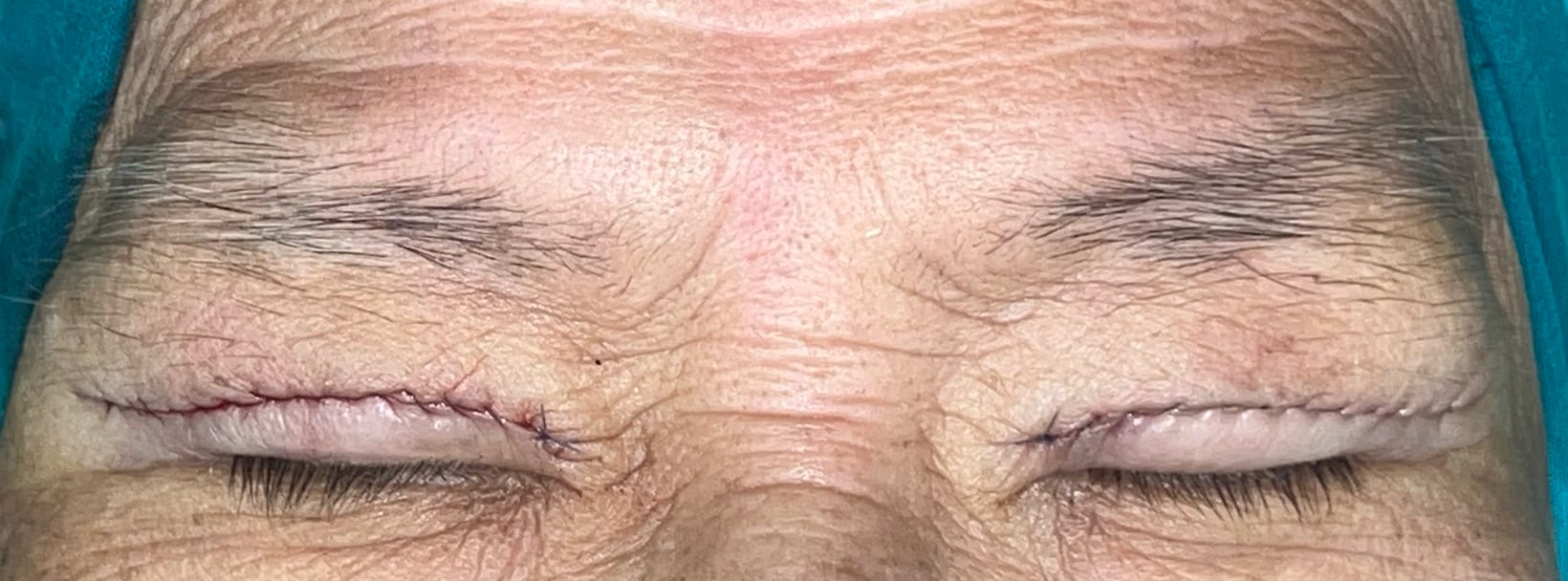 Immediate postoperative upper blepharoplasty appearance with eyes closed