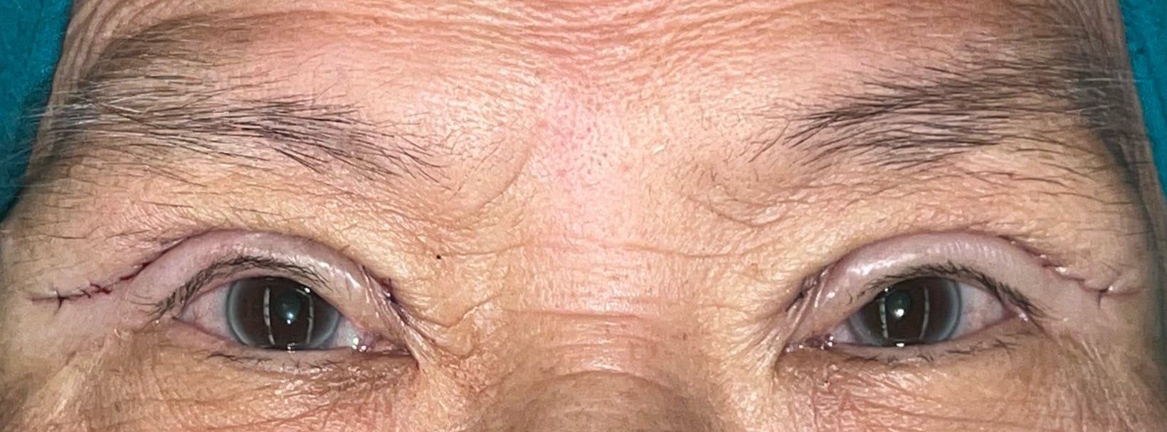 Immediate postoperative upper blepharoplasty appearance with eyes open
