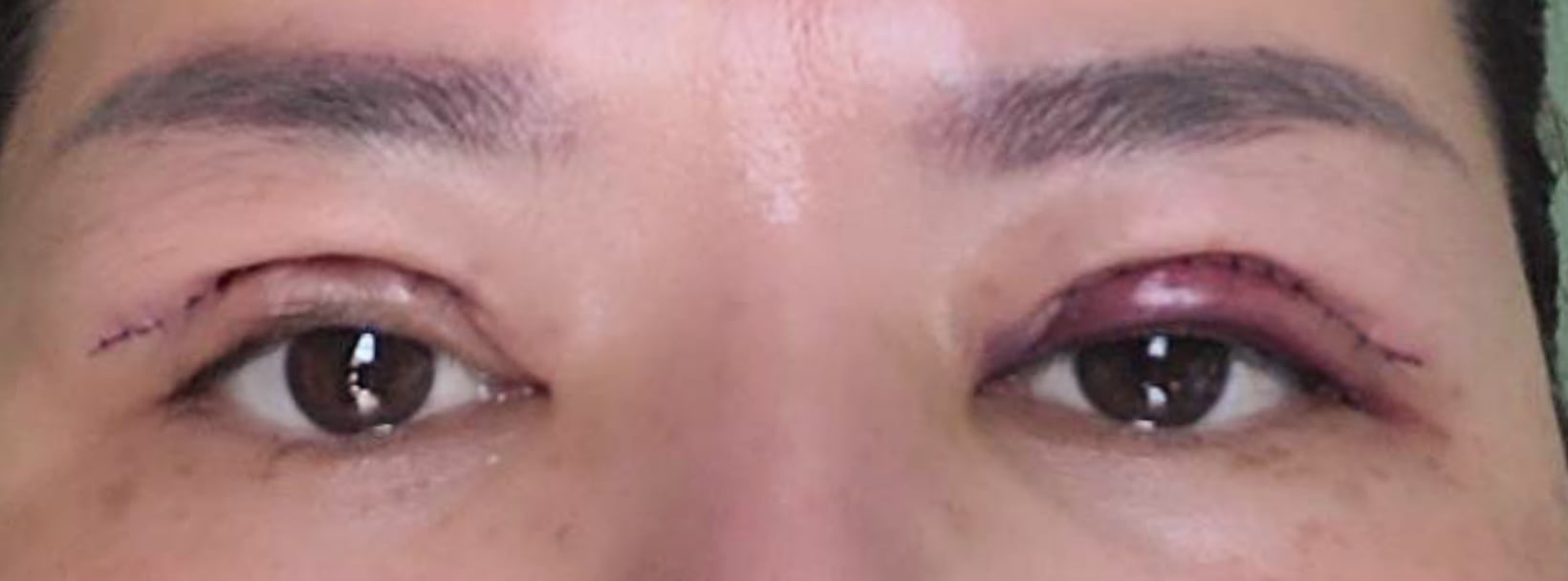 Upper blepharoplasty recovery at day 2