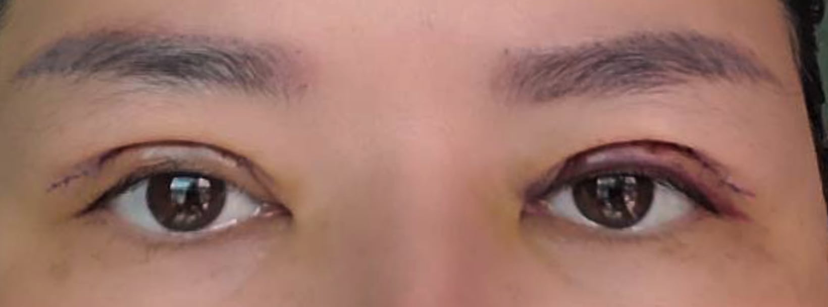 Upper blepharoplasty recovery at day 3