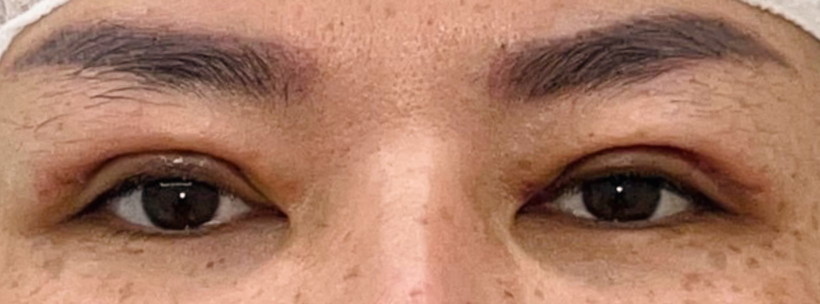 Upper blepharoplasty recovery at day 10