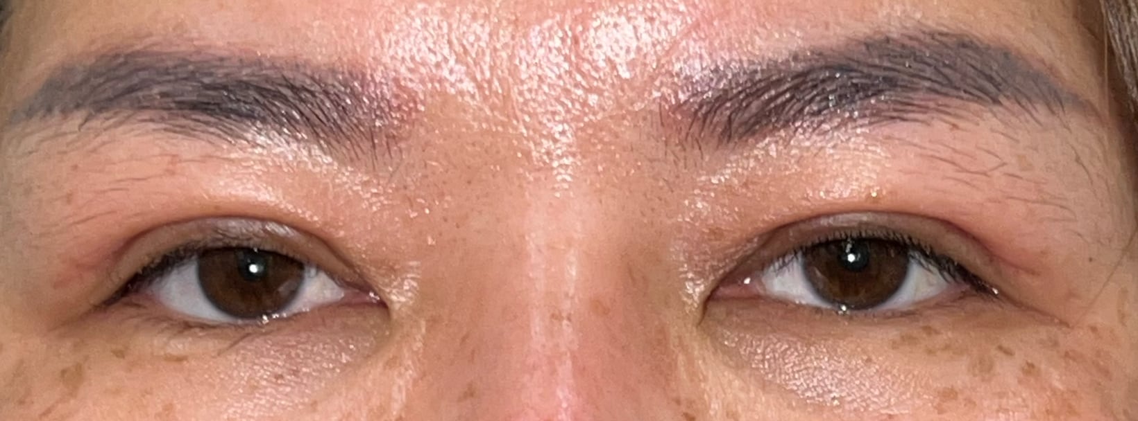 Upper blepharoplasty recovery at day 17