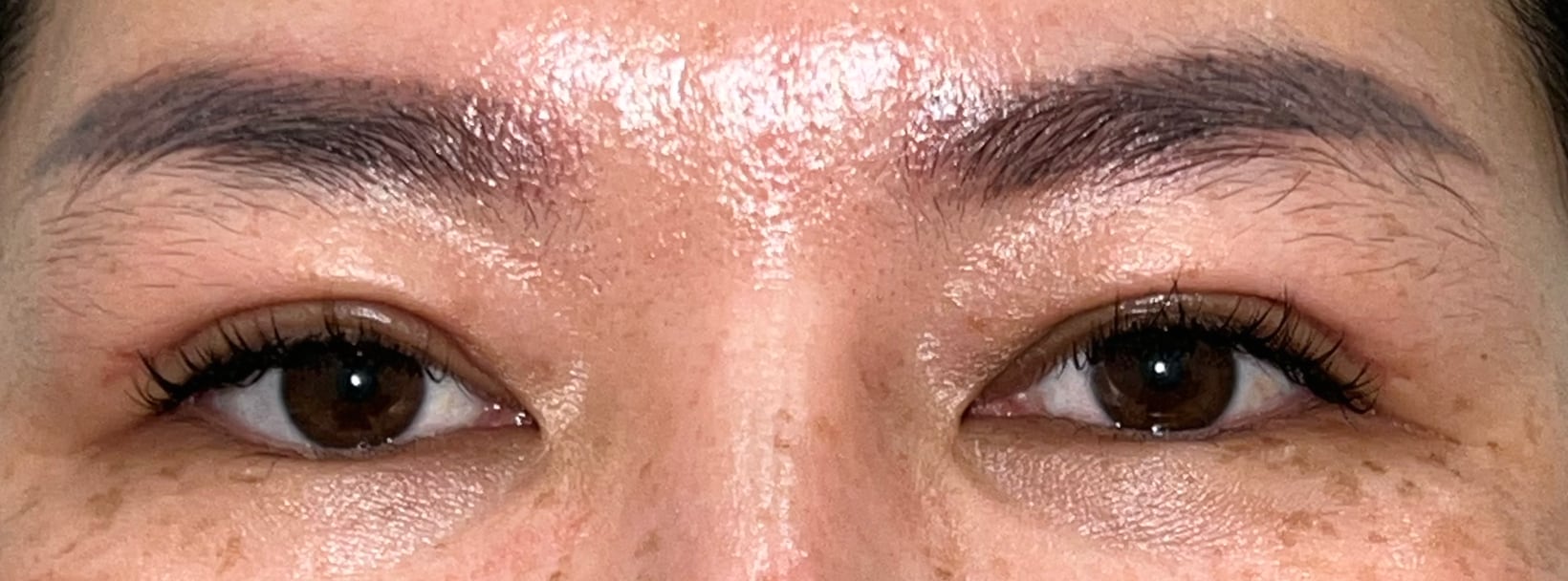 Upper blepharoplasty recovery at day 60