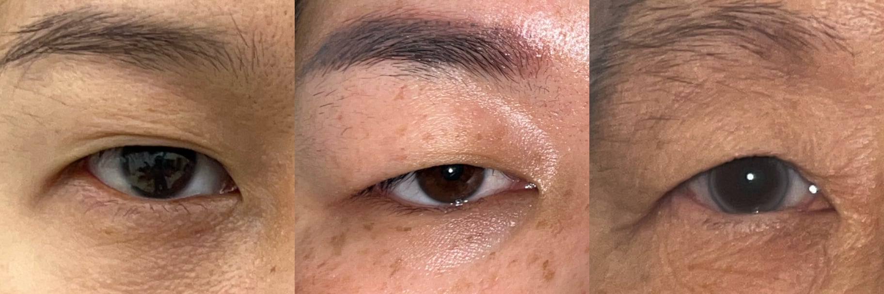 Clinical examples of upper eyelid anatomy relevant to upper blepharoplasty