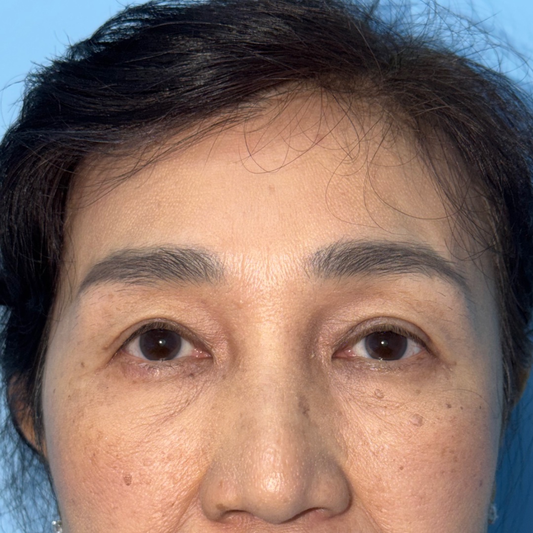 Case 1, 10-month follow-up after Endoscopic Brow Lift + Levator Advancement