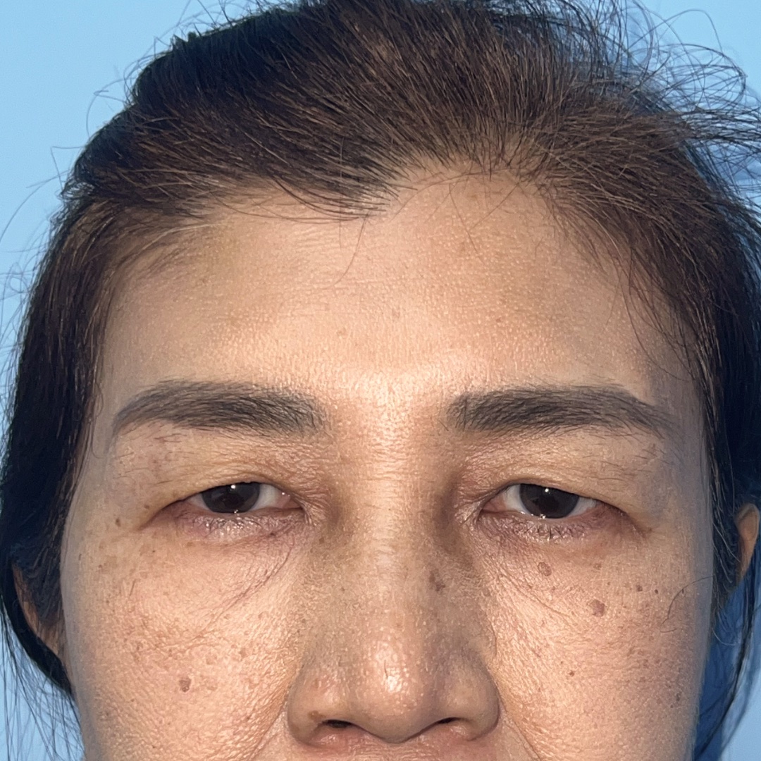 Case 1, before Endoscopic Brow Lift + Levator Advancement