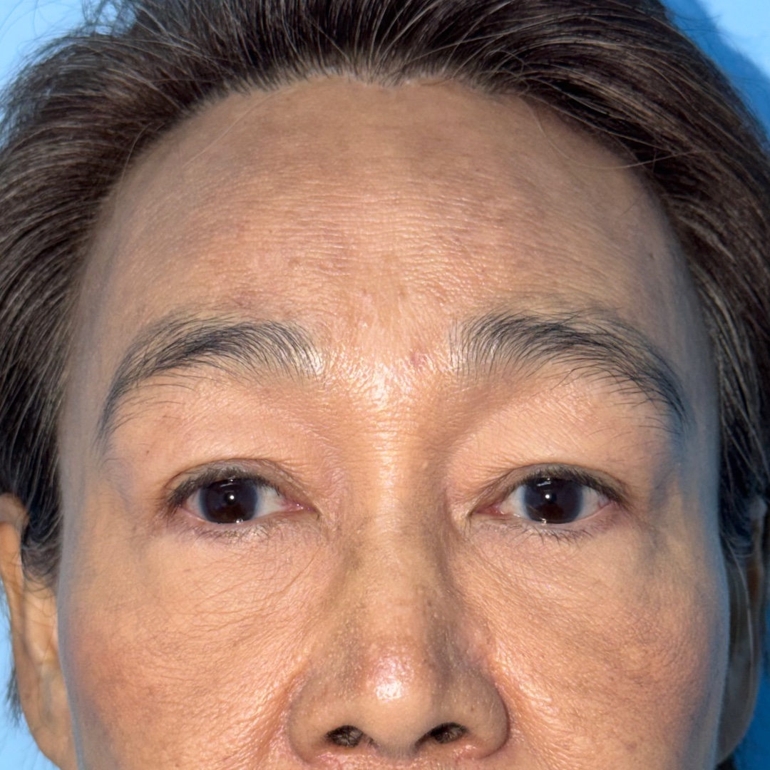 Case 2, 10-month follow-up after Hairline Forehead Lift + Upper Blepharoplasty