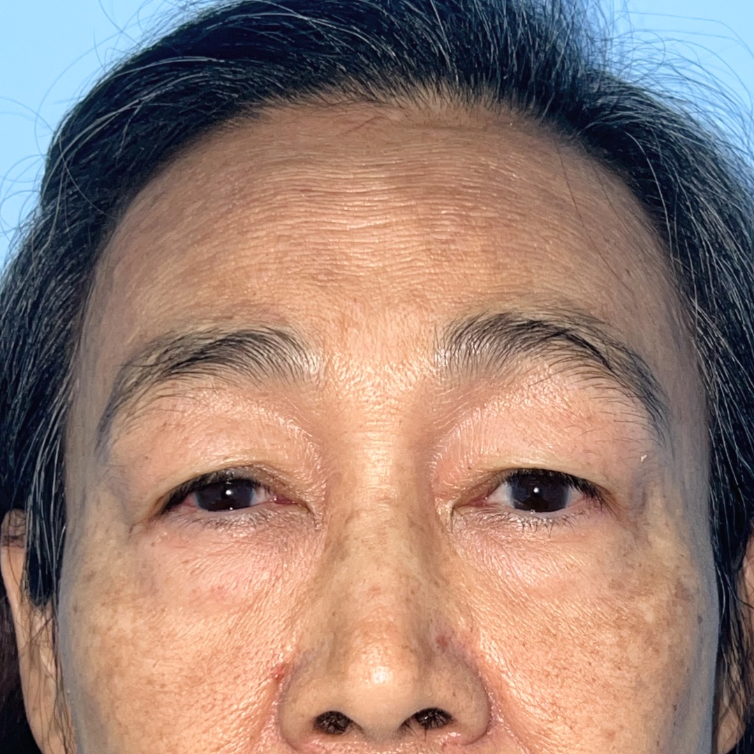 Case 2, before Hairline Forehead Lift + Upper Blepharoplasty