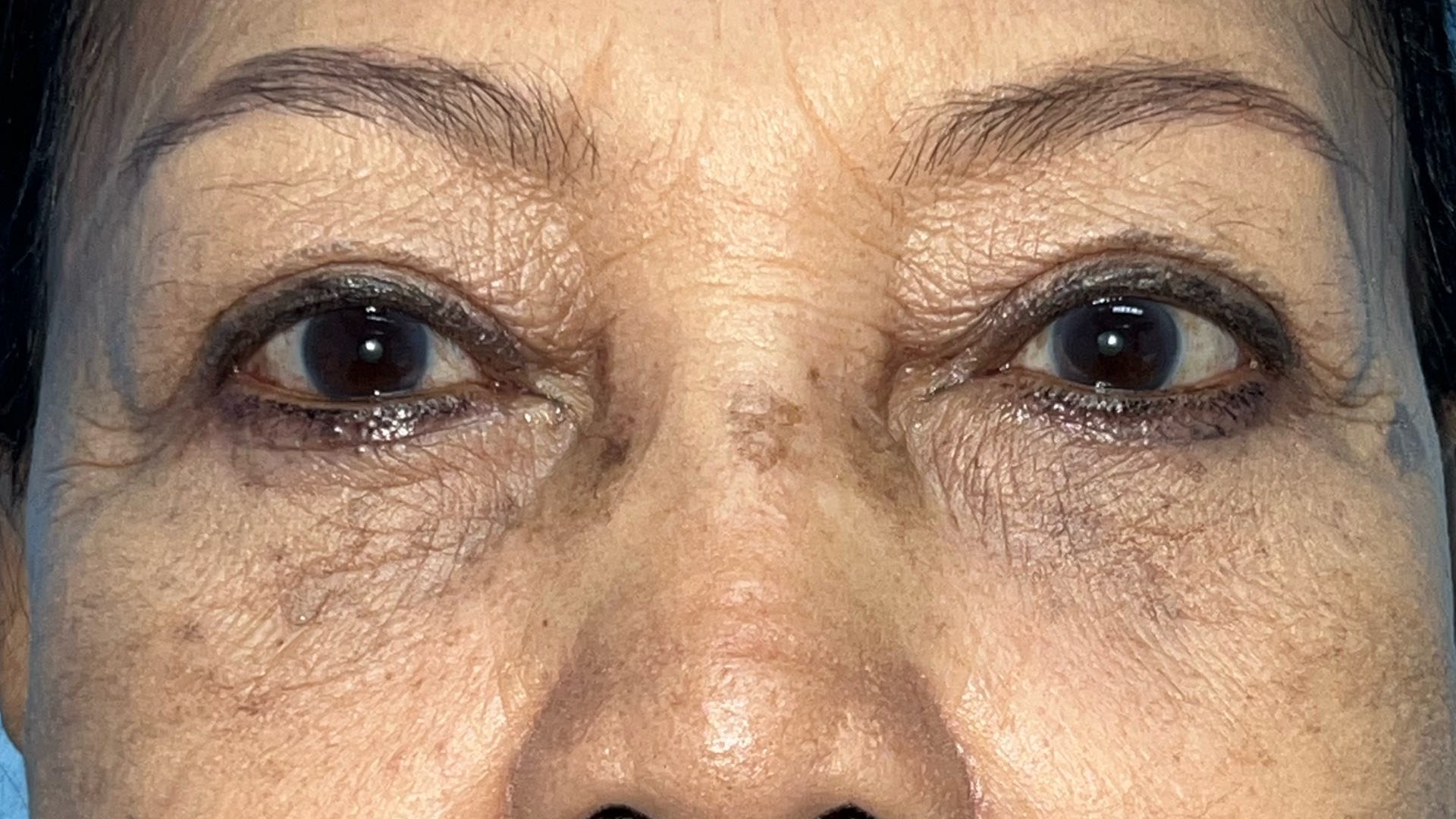 Case 3, 2-month follow-up after Lower Blepharoplasty