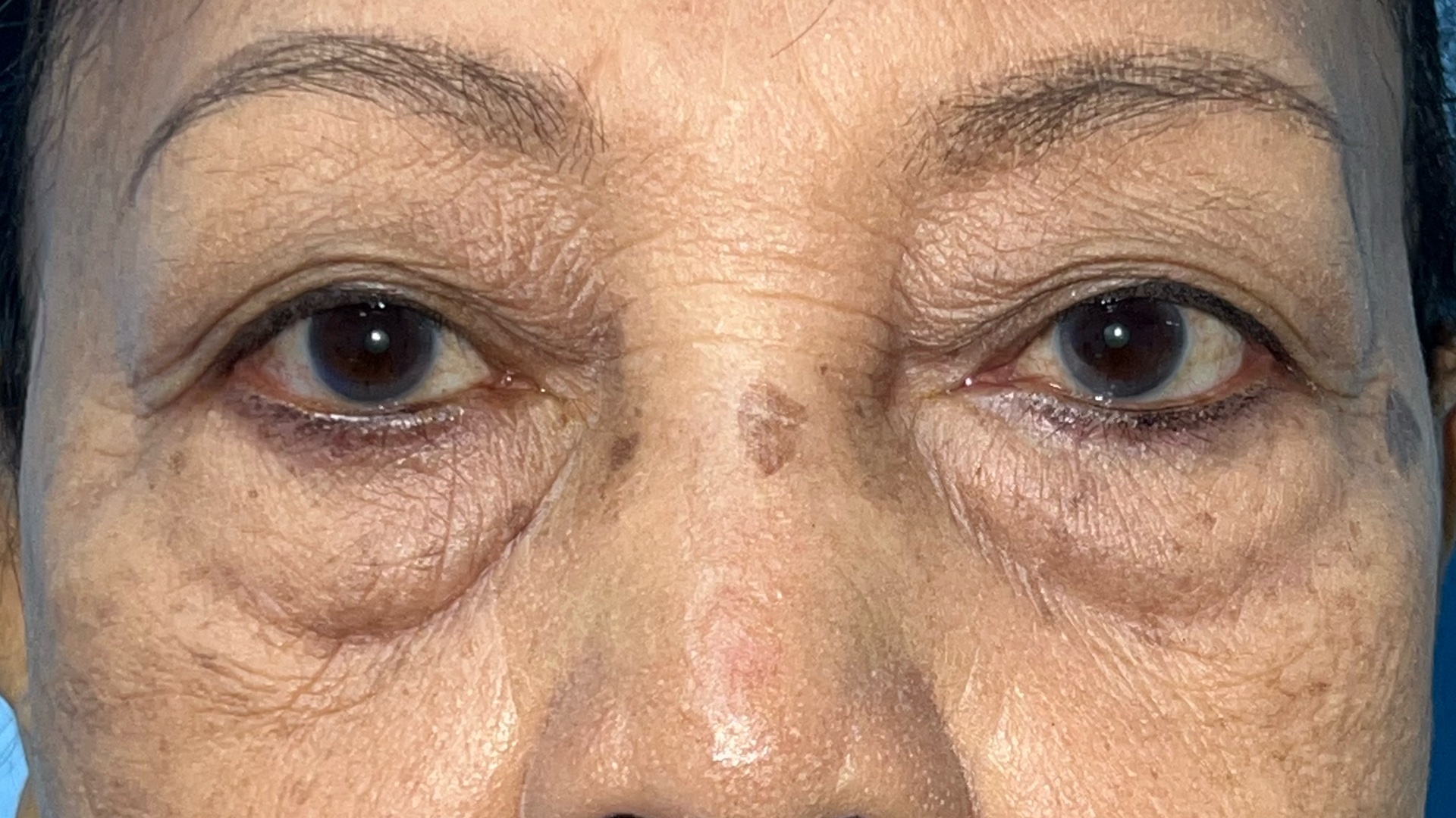 Case 3, before Lower Blepharoplasty