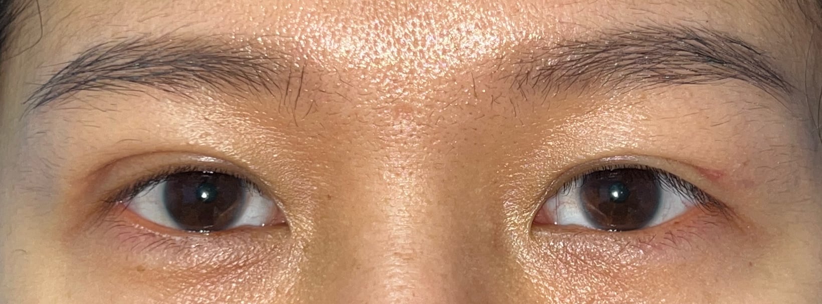Four months after upper blepharoplasty