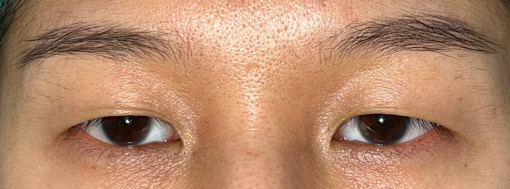 Before upper blepharoplasty