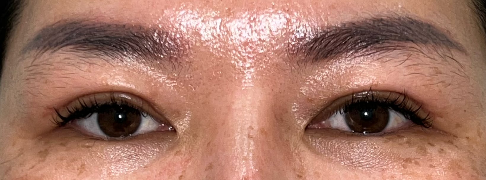 Two months after upper blepharoplasty
