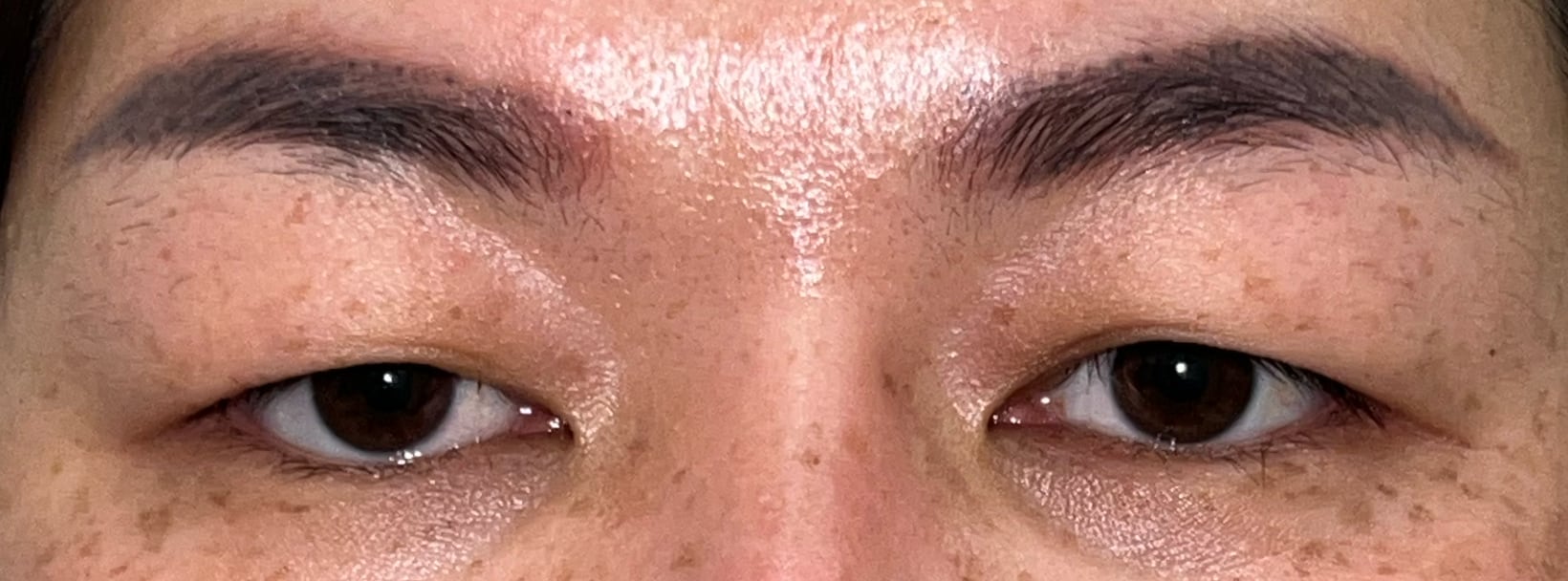 Before upper blepharoplasty