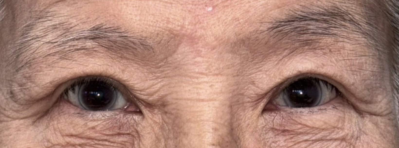 Three months after upper blepharoplasty