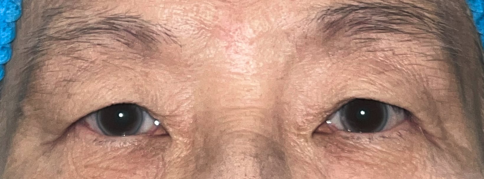 Before upper blepharoplasty