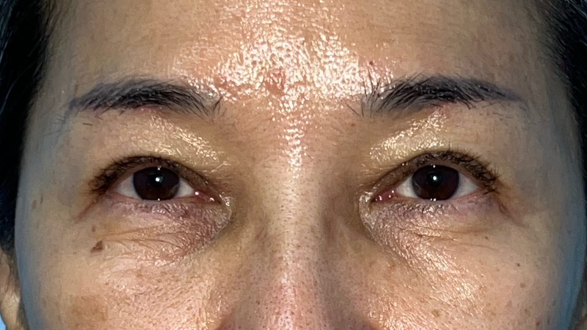 Six months after levator advancement for ptosis
