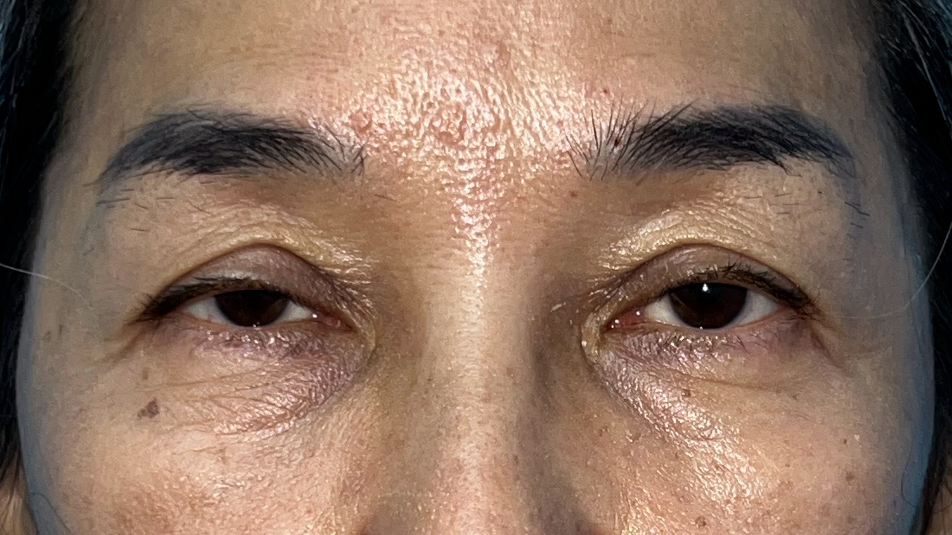 Before levator advancement for ptosis